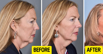 “She Looks 20 Years Younger,” a Woman Undergoes Transformative Surgery and Leaves Everyone Speechless