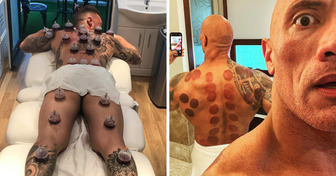 The Ancient Healing Therapy These 8 Celebrities Do, and What Doctors Say About the Procedure