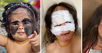 A Little Girl Was Called a ’Monster’ Because of Her Birthmark, Until Her Mom Brought Back Her Sweet Smile