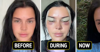 Young Woman Shares Her Fox Eye Surgery Journey—The Results Are Leaving People in Shock