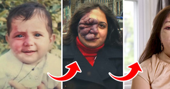 “People Said I Shouldn’t Leave The House,” Woman Who Was Born with Rare Birthmark Finally Get Her Confidence Back