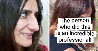 20+ Girls Who Decided to Get Plastic Surgery and Proved There Are No Limits When It Comes to Perfection